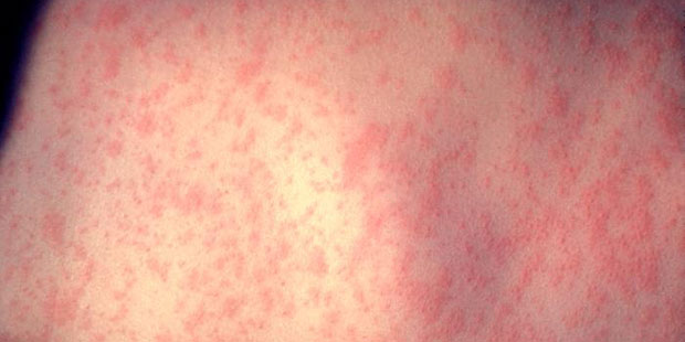 (Centers for Disease Control Photo)...