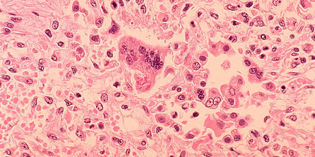 Histopathology of measles pneumonia. (Centers for Disease Control Photo)...