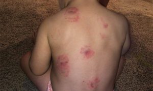 2 Arizona children bitten while at different daycare facilities