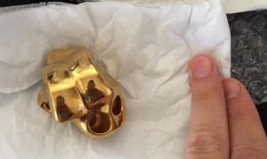 Mesa man receives first 3D-printed ankle replacement in Arizona