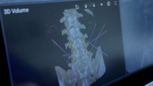 Glendale hospital enhances spinal fusion procedures with GPS-guided robotic arm