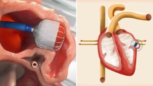 Arizona hospital becomes state's 1st to implant new device to reduce stroke risk